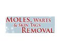 Moleswartsremoval.com Coupon Code